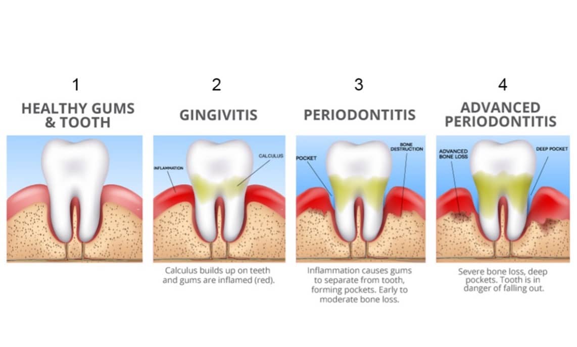 diagram of advanced periodontitis