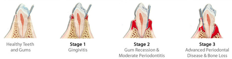 3 stages of avdnaced periodontal disease and bone loss